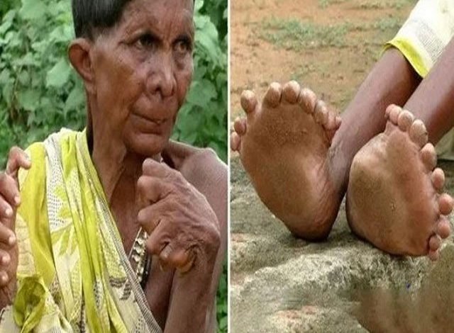 31 انگلیوں والی خاتون 1 1895975 indianladyhavingfingers 1574779684 555 640x480