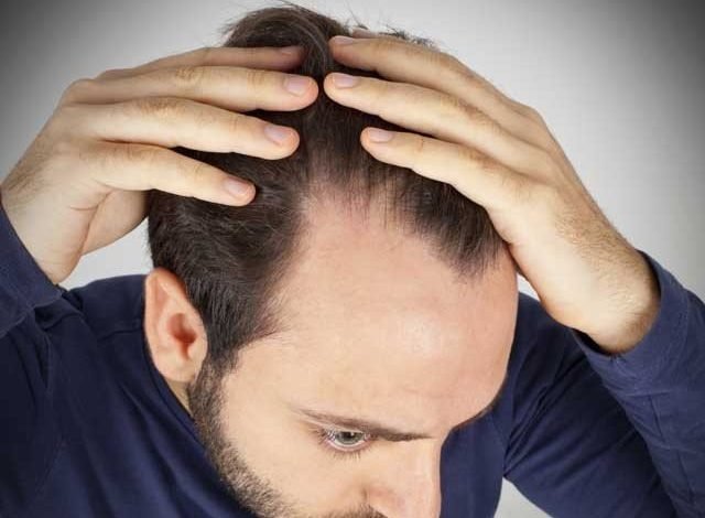 5 baldnessx 1