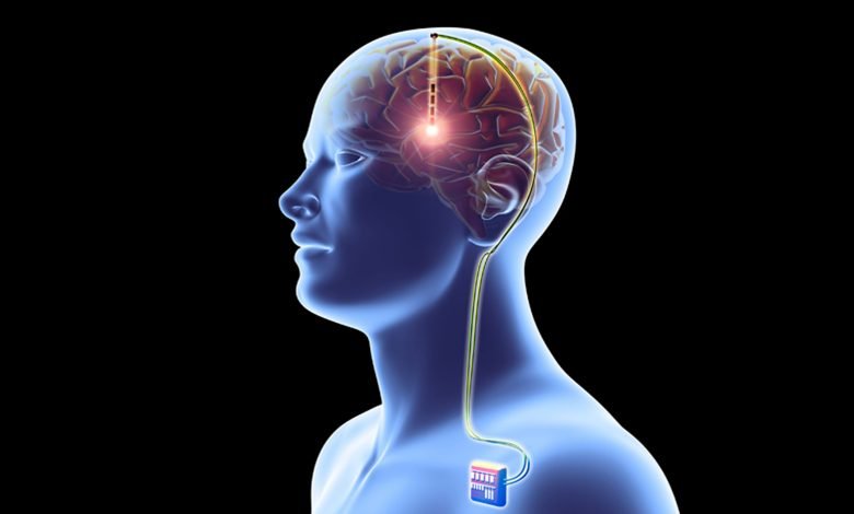 پاکستان میں مرگی سے بچاؤکیلیے 'برین پیس میکر' ڈیوائس لگانے کا آغاز 1 brain pacemaker device