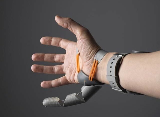 Successful experiment with extra thumb implants on hands without surgery
