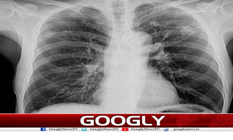 Anti Tuberculosis Compound News