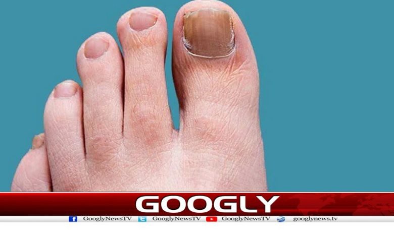 Easy Ways to Get Rid of Nail Fungus