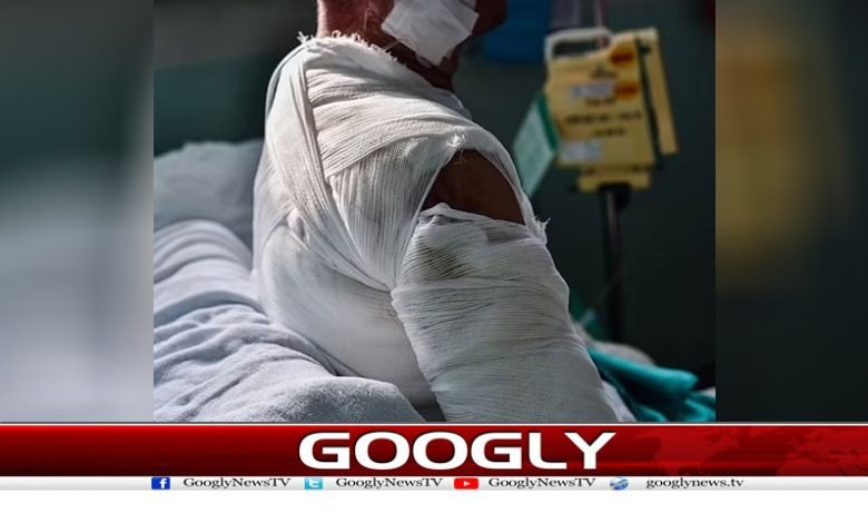 شدید جلے جسم پر جِلد لگانے کا نیا طریقہ کار وضع 1 skin