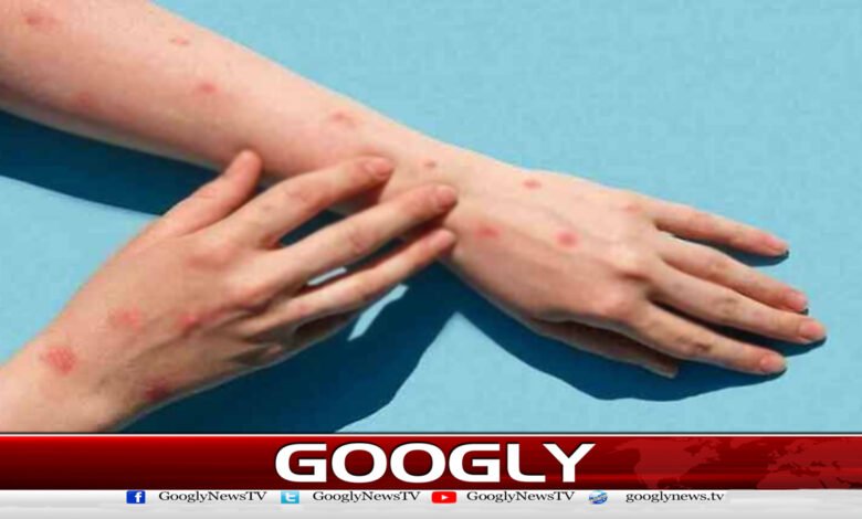 پاکستان میں منکی پاکس کا پہلا مشتبہ کیس سامنے آگیا - The first suspected case of monkeypox came to light in Pakistan