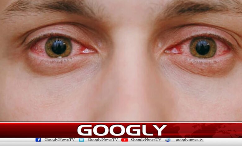 Conjunctivitis epidemic spreads in Karachi