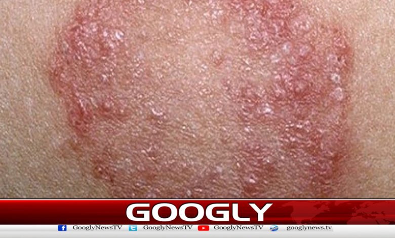 Pakistan develops medicine for fungal skin infection