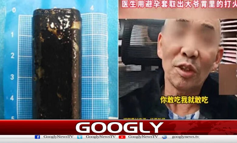 چین: فعال لائٹر شہری کے پیٹ سے 30 سال بعد برآمد ہوگیا 1 China: Active lighter recovered from citizen's stomach after 30 years