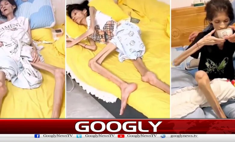 A 27-year-old woman who suffered from unusual weight loss has died.