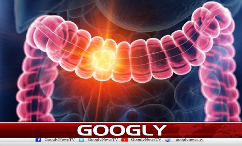 Bowel cancer has become a major cause of death