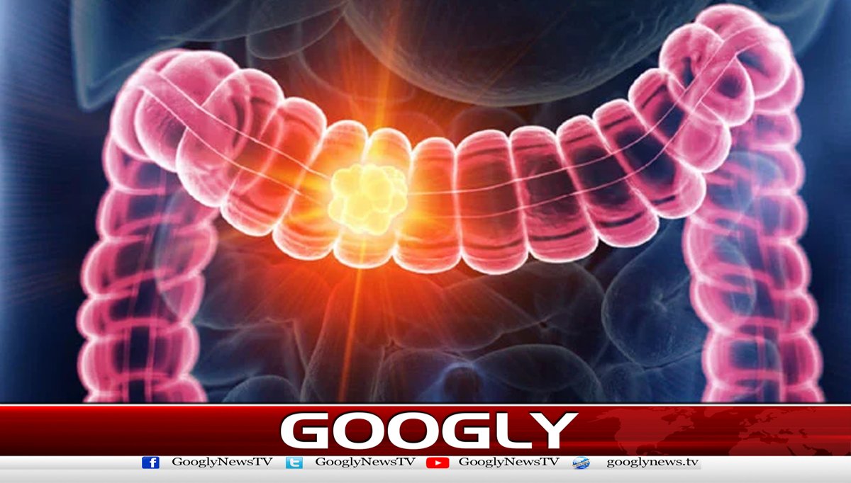 آنتوں کا کینسراموات کی بڑی وجہ بن گیا