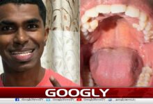 Malaysian man has 42 teeth extracted from his mouth
