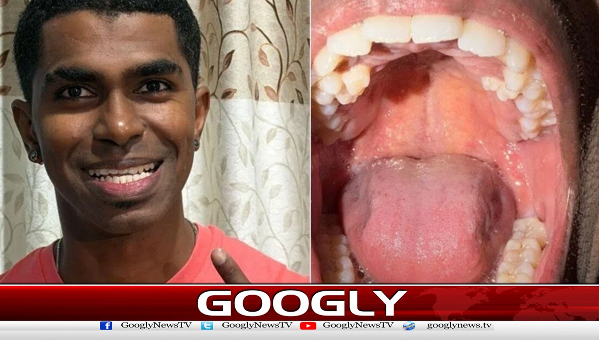 ملائیشیا کے باشندے کے منہ میں 42دانت نکل آئے