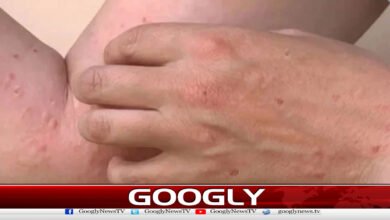 کراچی:رواں سال منکی پاکس کا 10 واں کیس سامنےآگیا 2 Karachi: 10th case of monkeypox reported this year