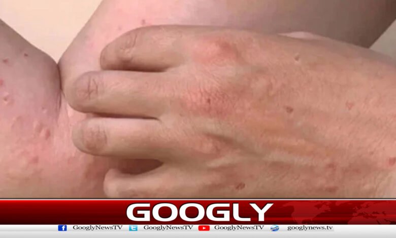 Karachi: 10th case of monkeypox reported this year