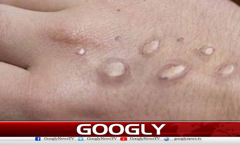 Another case of MPax has surfaced in Karachi
