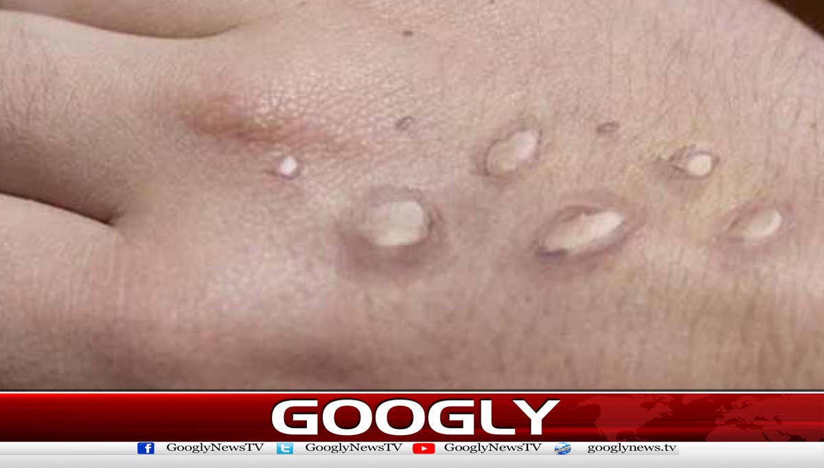 کراچی میں ایم پاکس کا ایک اور کیس سامنے آگیا