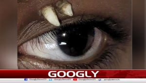India: Rare case of a tooth growing on an eye