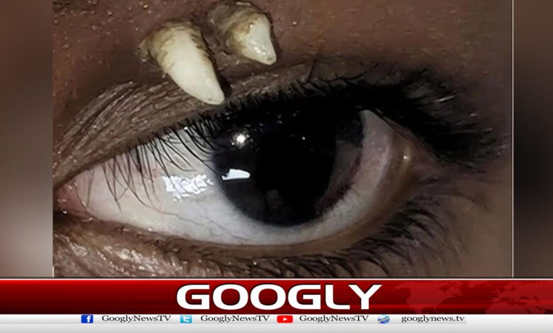 بھارت: آنکھ پر دانت نکلنے کا نایاب واقعہ 1 India: Rare case of a tooth growing on an eye