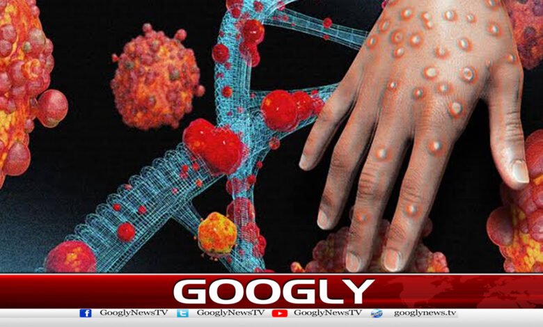کراچی میں منکی پاکس کاشکاربچہ جاں بحق 1 Child suffering from monkeypox dies in Karachi