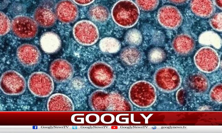 93 cases of mpox confirmed in Sindh this year.